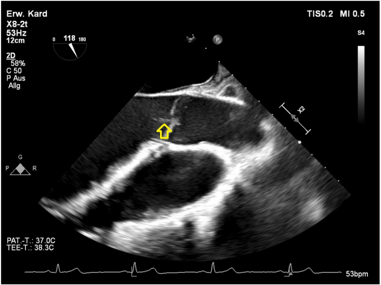 Gall bladder sludge and biliary pseudolithiasis as rare complications of ceftriaxone therapy in adult patients - A case report including sonographic workup.