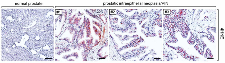 Increased Levels of Oxidative Stress in Human Prostate Intraepithelial Neoplasia and Prostate Cancer: Evidence from 4-Hydroxyneonal Detection and Its Implications.