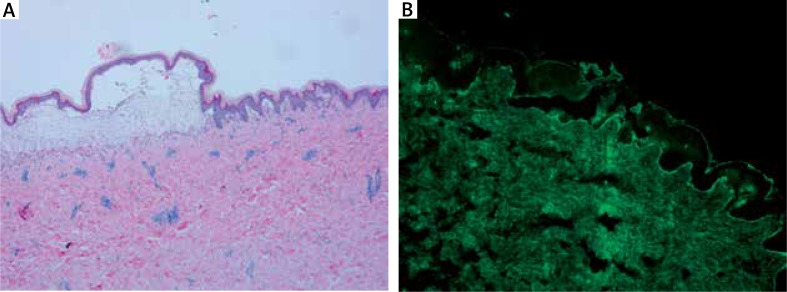 Linear IgA bullous dermatosis in a child after the second dose of inactivated COVID-19 vaccine.