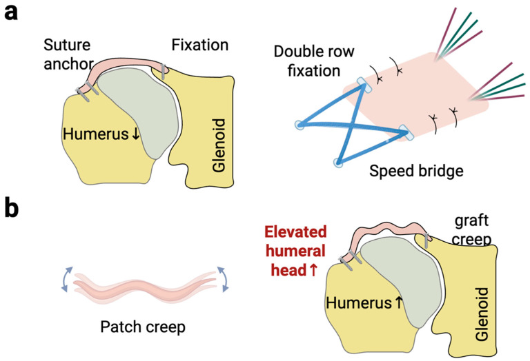 Superior Capsule Reconstruction Graft Selection: The Influence of Biological Properties of Grafts on Healing and Re-Tearing.