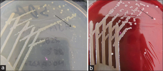 Actinomyces causing psoas abscess: Case report of a peculiar forgotten disease.