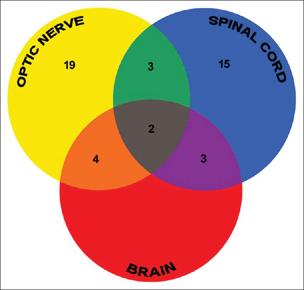 Neuroophthalmological evaluation in primary inflammatory demyelinating diseases with special reference to optic neuritis: A prospective study.