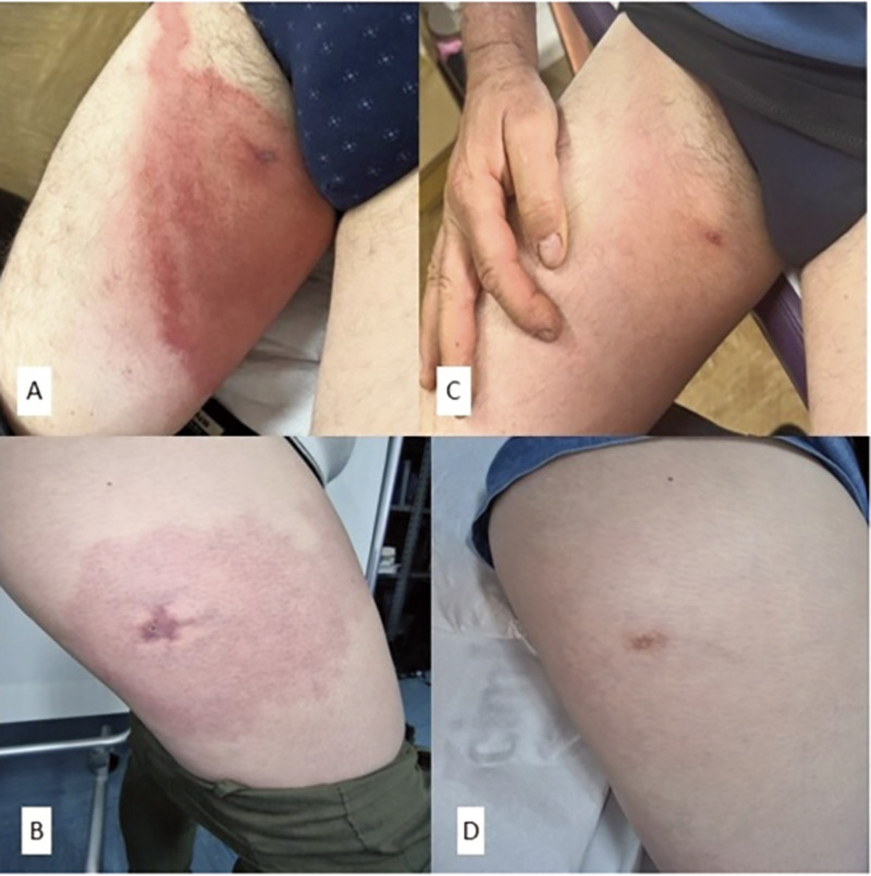 Novel therapeutic approach for loxoscelism: efficacy of cefixime and netilmicin sulfate combination therapy.