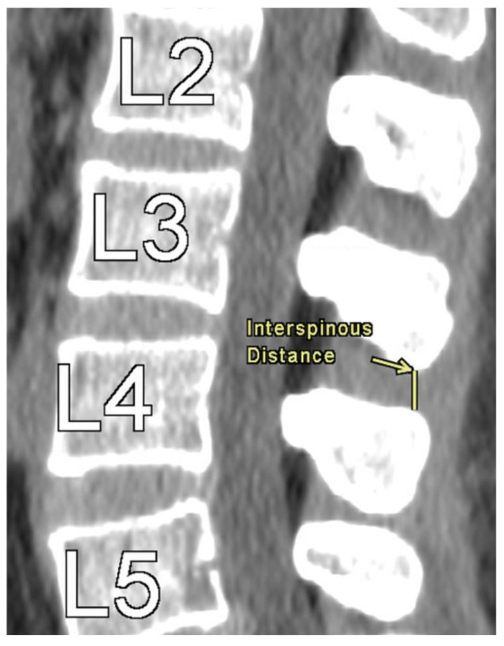 Correlations of Lumbar Interspinous Distance with Neuroforaminal Dimensions, Disc Space Height, and Patient Demographic Factors.