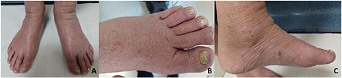 Cutaneous manifestations associated with unknown HIV infection: a case report.