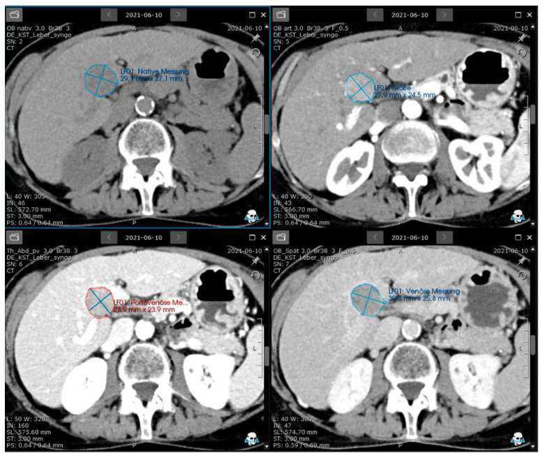 Enhancing LI-RADS Through Semi-Automated Quantification of HCC Lesions.
