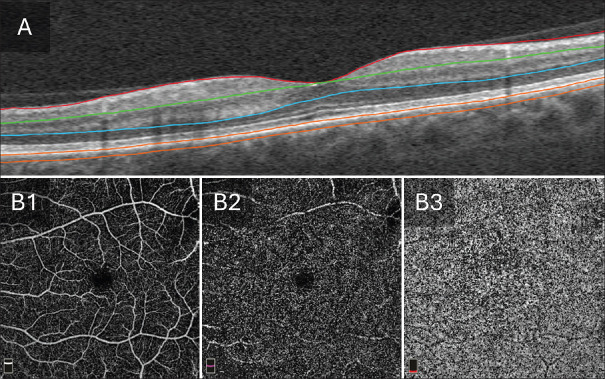 Quantitative optical coherence tomography angiography biomarkers of the choriocapillaris for objective detection of early diabetic retinopathy.