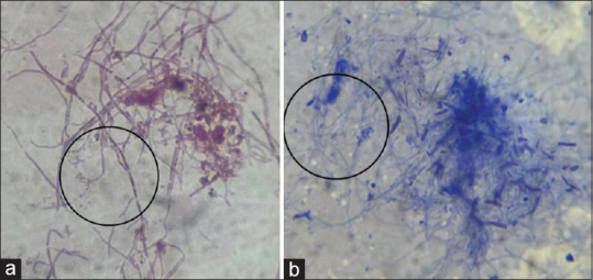 Actinomyces causing psoas abscess: Case report of a peculiar forgotten disease.