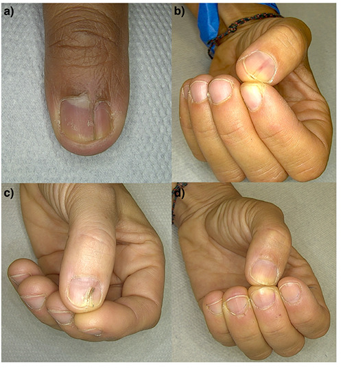 Complications in nail surgery and prevention strategies: a comprehensive review.