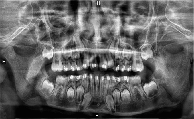 Management of Jaw Fractures in Pediatric Patients Using Orthodontic Appliances: A Case Series.