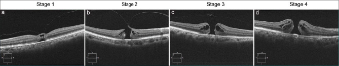 How optical coherence tomography has changed the management of macular holes: A narrative review.