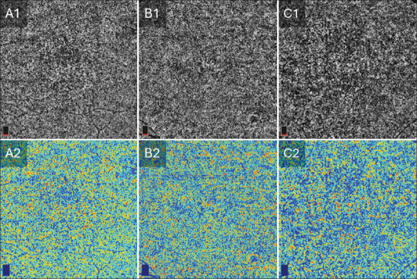 Quantitative optical coherence tomography angiography biomarkers of the choriocapillaris for objective detection of early diabetic retinopathy.
