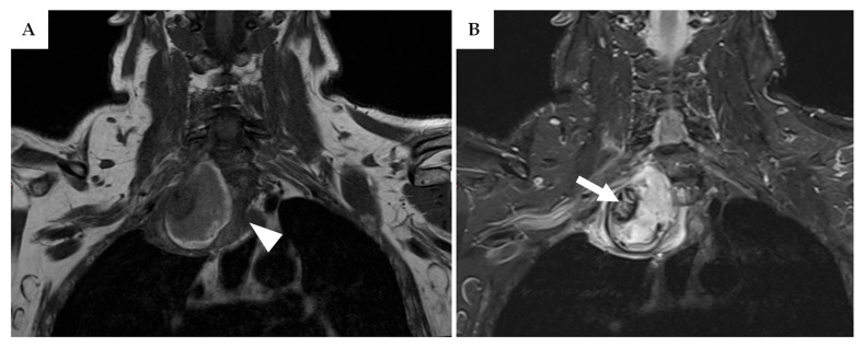 The Role of Pre-Operative Biopsy in Malignant Peripheral Nerve Sheath Tumours: A Review and Retrospective Series with a Management Algorithm from a Single-Center Experience.