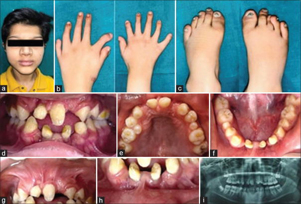 Navigating complexities: A pediatric case of Ellis-van Creveld syndrome.
