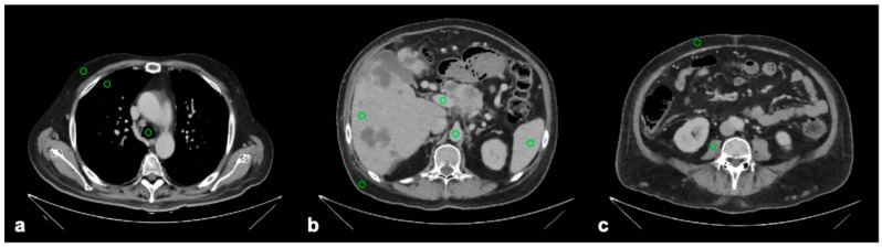 Performance of a Deep Learning Reconstruction Method on Clinical Chest-Abdomen-Pelvis Scans from a Dual-Layer Detector CT System.