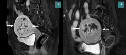 Comparison between non-spherical polyvinyl alcohol particles and tris-acryl gelatin microspheres after uterine artery embolization: a retrospective study.