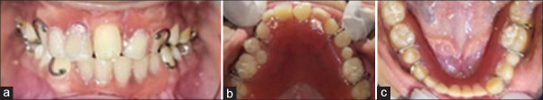 Navigating complexities: A pediatric case of Ellis-van Creveld syndrome.