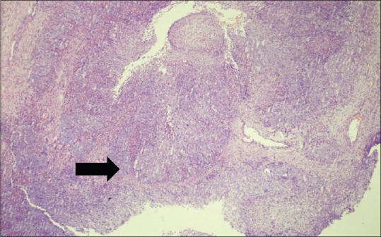 Sinonasal carcinoma: A rare case report.