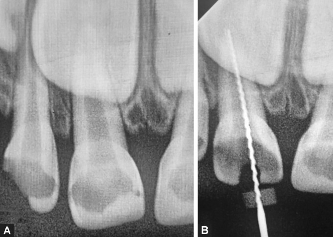 Comparison of Antibacterial Efficacy of Conventional Root Canal Irrigation System and Metronidazole, with and without Pro-agitator Tip System, in Primary Anterior Teeth: An <i>In Vivo</i> Study.