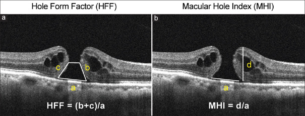 How optical coherence tomography has changed the management of macular holes: A narrative review.