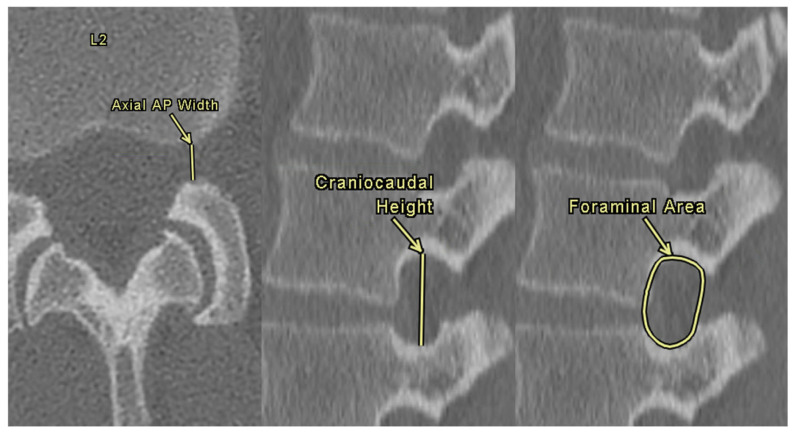 Correlations of Lumbar Interspinous Distance with Neuroforaminal Dimensions, Disc Space Height, and Patient Demographic Factors.