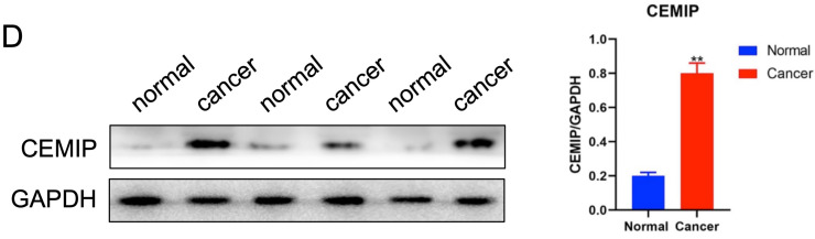 Erratum: <i>CEMIP</i> as a potential biomarker and therapeutic target for breast cancer patients: Erratum.