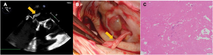 Recurrent Nonbacterial Thrombotic Endocarditis after Vegetectomy of Bioprosthetic Mitral Valve.
