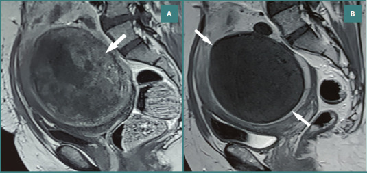 Comparison between non-spherical polyvinyl alcohol particles and tris-acryl gelatin microspheres after uterine artery embolization: a retrospective study.