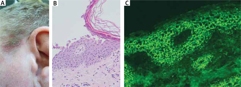 Effectiveness of direct immunofluorescence for diagnosing autoimmune bullous diseases: data from the Central European referral department.