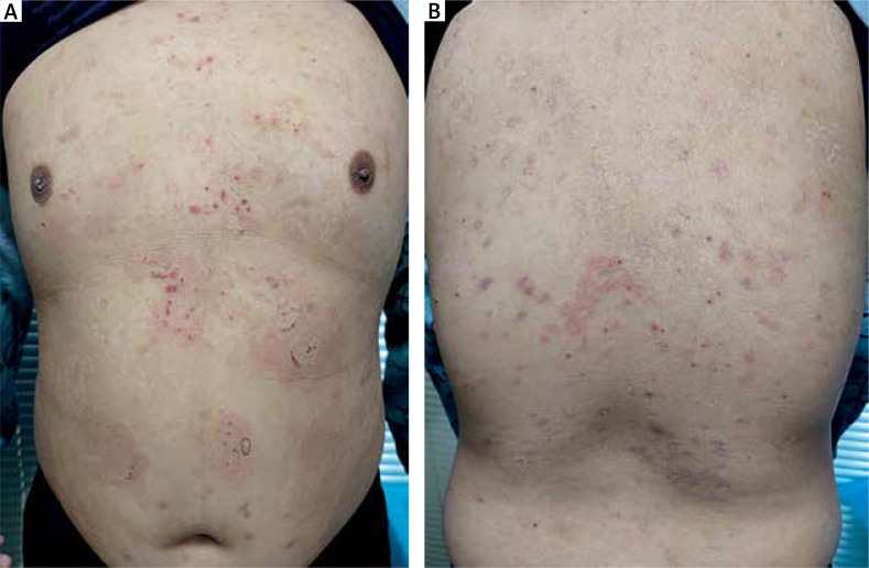 Linear IgA bullous dermatosis in a child after the second dose of inactivated COVID-19 vaccine.
