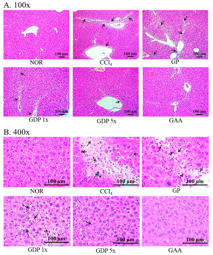 Sublingual Dripping Pill Formulation of <i>Ganoderma amboinense</i> Fruiting Body Extract Attenuates CCl<sub>4</sub>-Induced Liver Fibrosis via Multi-Pathway Regulation.