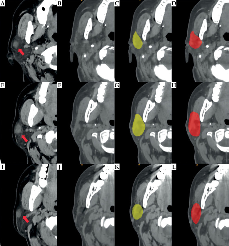 Deep learning-based auto-segmentation model for clinical target volume delineation in brachytherapy after parotid cancer surgery.