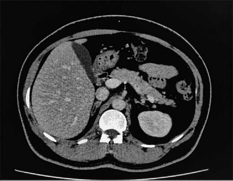 Recurrent hypokalemia induced by primary aldosteronism due to unilateral adrenal adenoma. A case report.