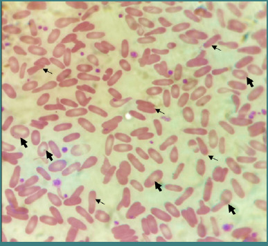 Hereditary elliptocytosis in a child with an autosomal recessive <i>SPTA1</i> mutation: a case report from Saudi Arabia.