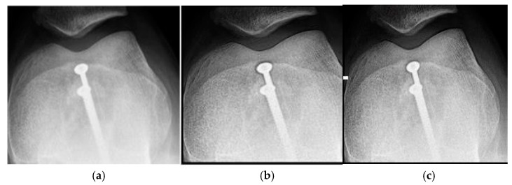 Dual-Filter X-Ray Image Enhancement Using Cream and Bosso Algorithms: Contrast and Entropy Optimization Across Anatomical Regions.