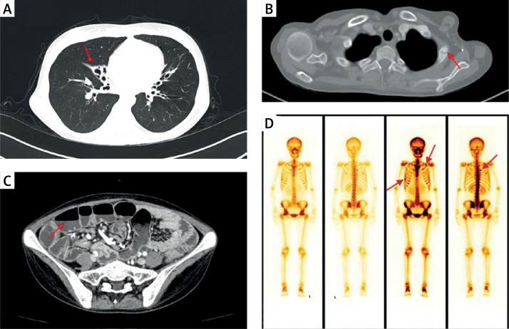 Common variant immunodeficiency with refractory diarrhea and osteomalacia.