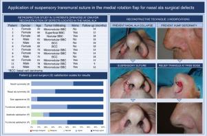 [Translated article] Application of Transmurally Suspensory Suture in the Medial Rotation Flap for Surgical Defects of the Nasal Ala