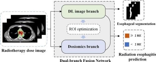 Dosiomics-guided deep learning for radiation esophagitis prediction in lung cancer: optimal region of interest definition via multi-branch fusion auxiliary learning