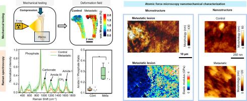 The microstructure of metastatic bone lesions suggests tumor mediated alterations in bone mineralization