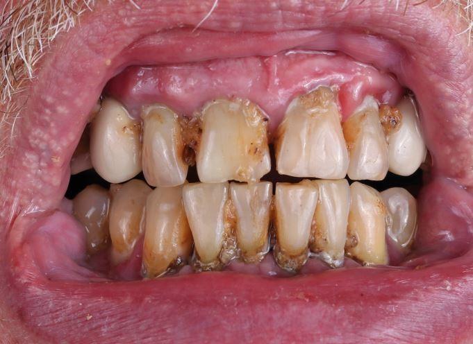 Don't meth around - rotten smiles and silent pain