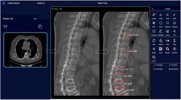 Development and multi-center validation of a software program, Ofeye 3.0, for automated all-inclusive vertebral fracture detection with chest/abdominal CT images