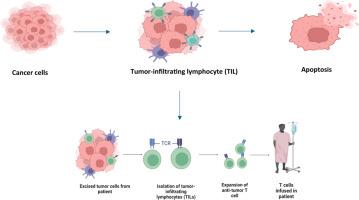 Current perspectives on Lifileucel tumor-infiltrating lymphocyte therapy: A paradigm shift in immunotherapy