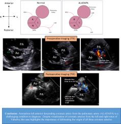 Anomalous Origin of the Left Anterior Descending Artery From the Pulmonary Artery in an Infant With TMCO1 Mutation and Cohen Syndrome