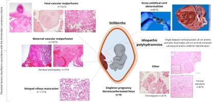 Hidden placental damage in stillbirths with idiopathic polyhydramnios