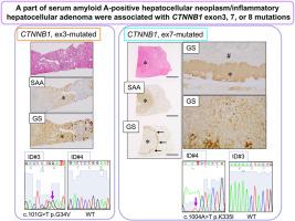 CTNNB1 mutations in serum amyloid A-positive hepatocellular neoplasm/inflammatory hepatocellular adenoma arising in alcoholic cirrhosis