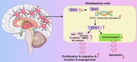 Role of SIX5-mediated EXO1 overexpression in driving glioblastoma progression: Insights into tumor cell migration and angiogenesis