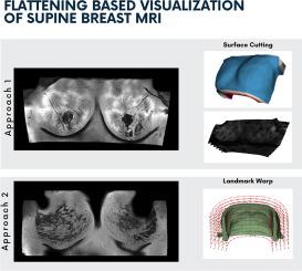 Flattening-based visualization of supine breast MRI