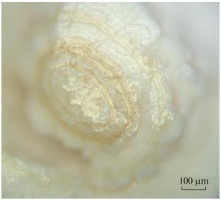 Features of the Morphology and Composition of Stones in the Human Body in the Study of the Mechanisms of Their Formation