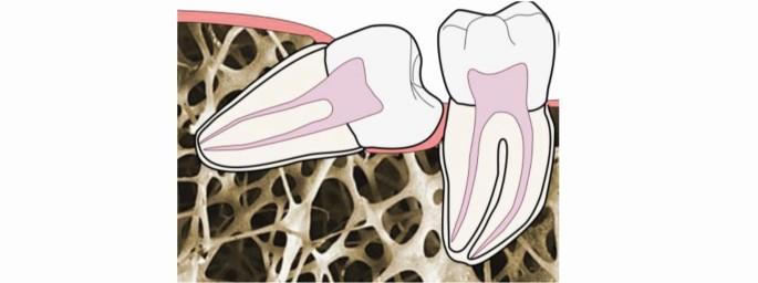 Prevalence of disease associated with horizontal and mesioangular-impacted mandibular third molars in relation to age