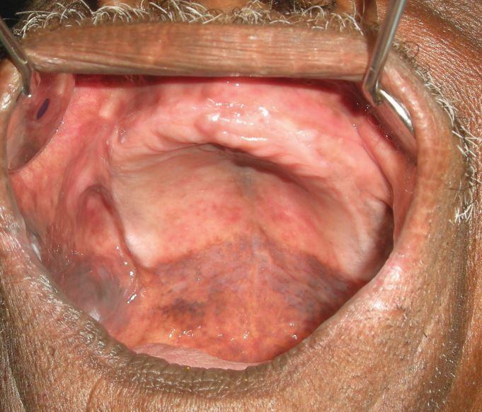 Half and half smoker's melanosis